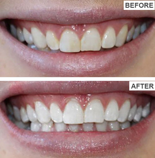Teeth-Cleaning-Before-and-After-7-1